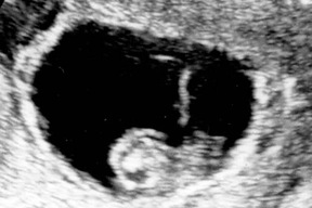 7-week ultrasound image showing developing baby