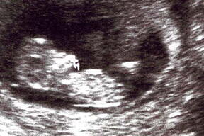Ultrasound image of baby at 9 weeks pregnant showing early development